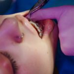 Ortodonta zakłada aparat na zęby