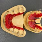 ruchomy aparat ortodontyczny